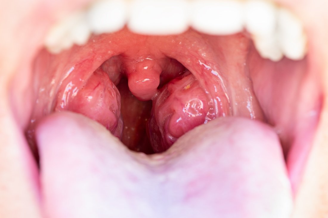 Effective Ways to Identify Tonsil Stones: Symptoms and Solutions for 2025