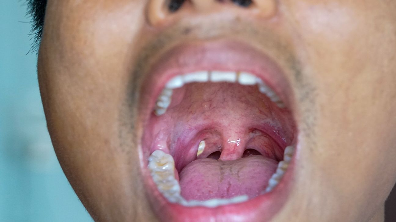 Effective Ways to Remove Tonsil Stones at Home in 2025: Discover Practical Tips