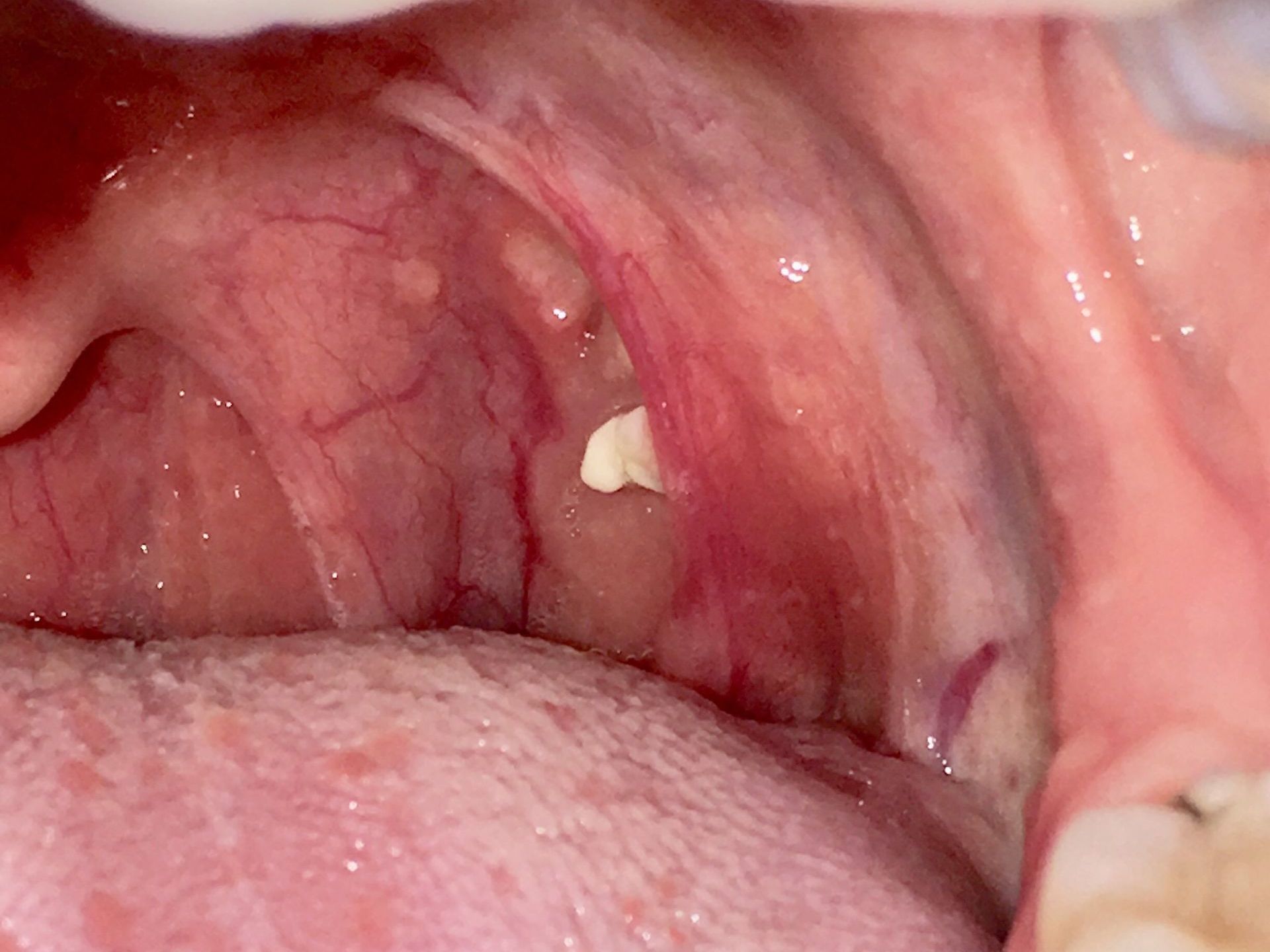 Tonsil Stones Treatment