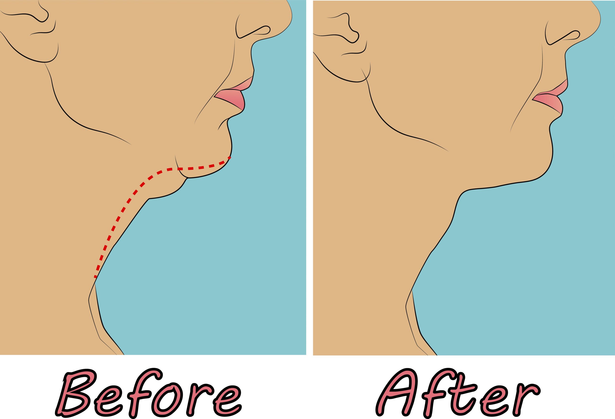 Effective Ways to Get Rid of Double Chin Fast and Succeed in 2025