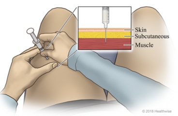 Smart Ways to Inject Testosterone Effectively in 2025: Achieve Better Results