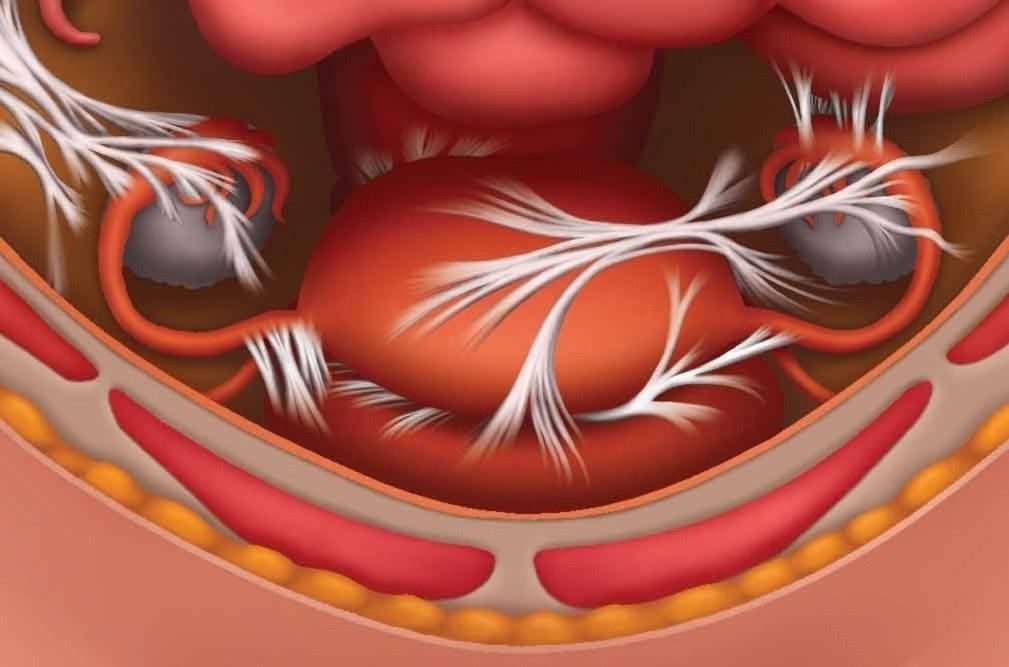 Effective Ways to Dissolve Adhesions Without Surgery in 2025: Discover Proven Techniques for Healing