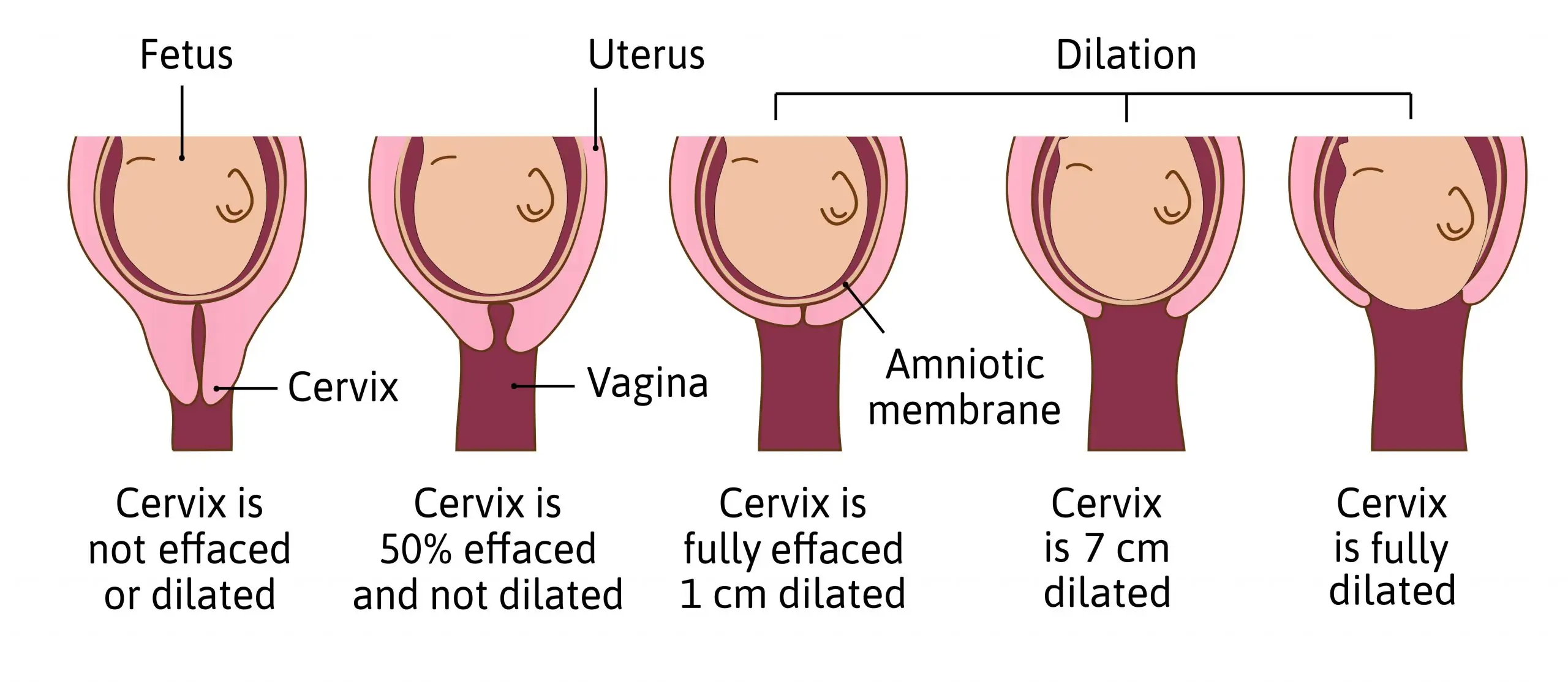 How to Effectively Recognize Signs of Dilation During Pregnancy in 2025